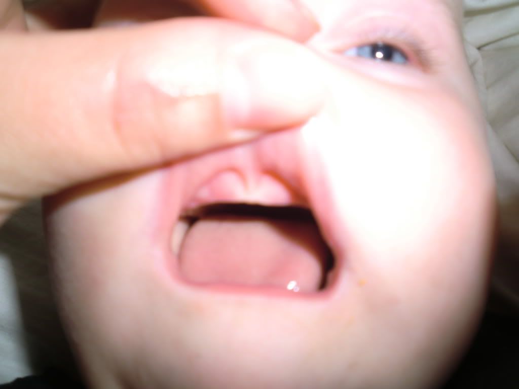 Does she have four teeth coming through at once? (photos ...