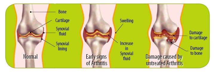 arthritis knee. juvenile arthritis knee.